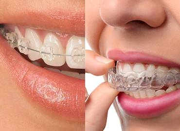 aligners and braces treatment in gurgaon