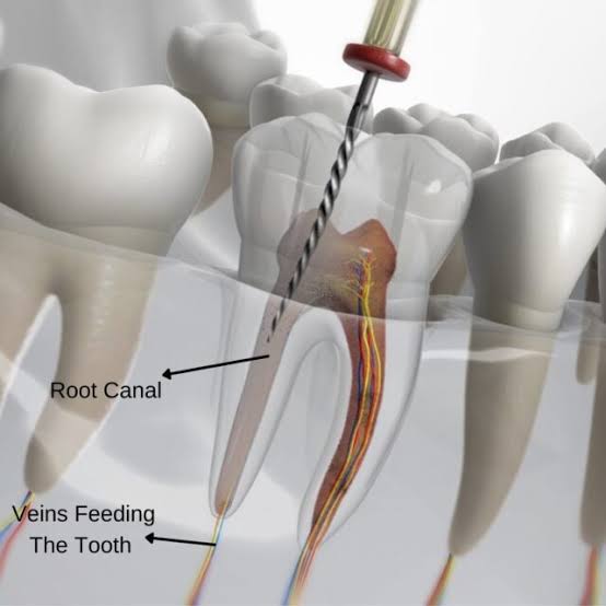 root canal treatment in gurgaon