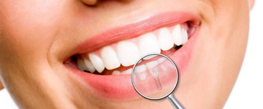 dental implants treatment in gurgaon
