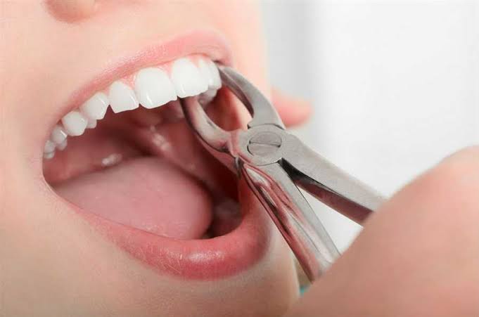 Best dental clinic for tooth extraction in Gurgaon